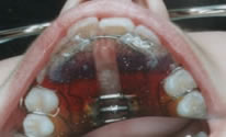 Removable Braces